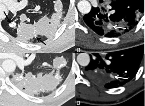 A Chest Ct Scan Performed On The Patients Emergency Arrival In