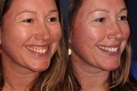 Gummy Smile Reduction San Diego Ca Cosmetic Laser Dermatology