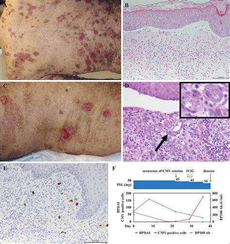 Jle European Journal Of Dermatology Cytomegalovirus Induced Skin