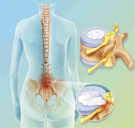 Warning Signs You May Have A Lumbar Herniated Disc Web Bloggers