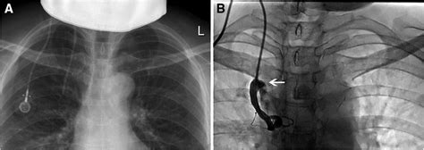 Catheter Malposition To Internal Thoracic Vein A The Chest X Ray
