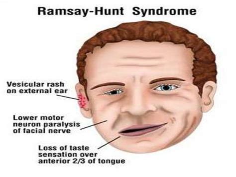 Ramsay Hunt Syndrome Dentowesome
