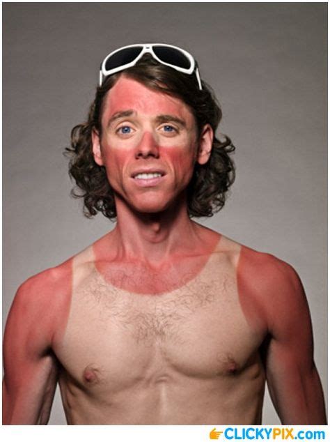 Bad Sunburns Ideas Bad Sunburn Sunburn Funny Sunburn