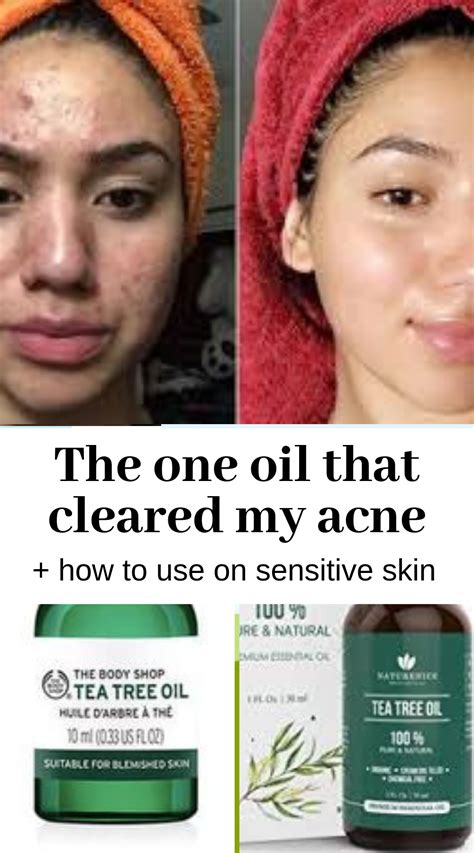 How To Use Tea Tree Oil To Cure Acne In Sensitive Skin Acne Tea Tree