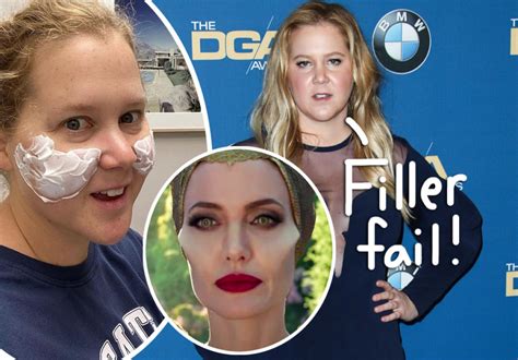 Amy Schumer Got Botched Plastic Surgery And Immediately Undid It I