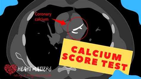 All About The Calcium Score Heart Scan Youtube