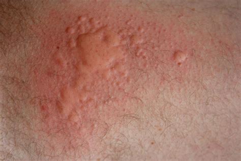 The rash will appear in different ways, depending on the trigger that caused the reaction. Food Allergies