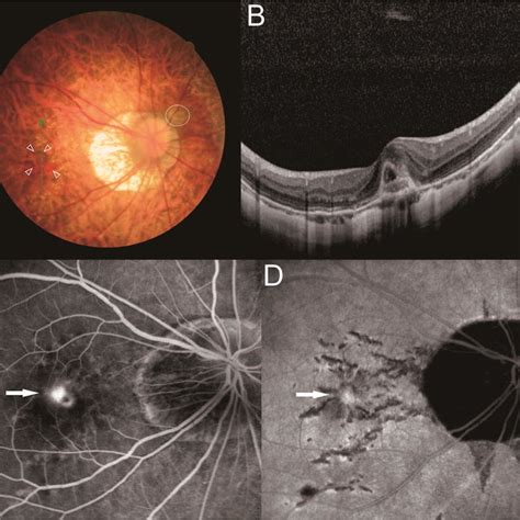 Development Of Myopic Cnv From Lacquer Cracks Patient 3 A 28 Year Old