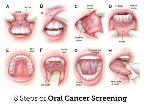 Oral Cancer Screening White Bear Lake Dentist Mn 55110 Periodontal Associates Connie A