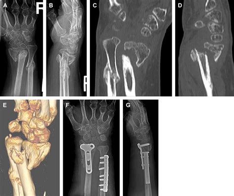 Complications Of Distal Radius Fractures Orthopedic Clinics