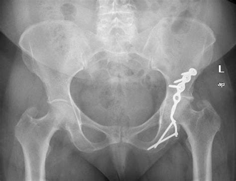 Case 1 Anteroposterior And Lateral Pelvis Radiographs Demonstrating