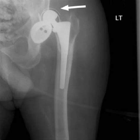 Right Total Hip Replacement With Loosening Of The Acetabular Component Download Scientific