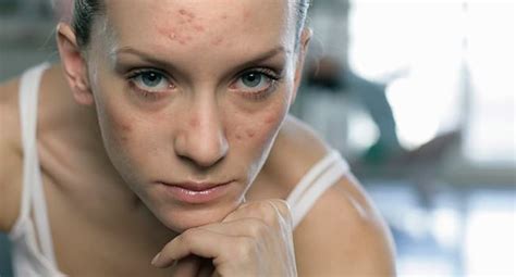 Adult Acne Causes Treatments And More