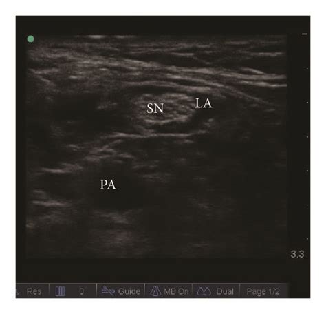 Ultrasound Image Of The Common Peroneal Nerve And Tibial Nerve At The