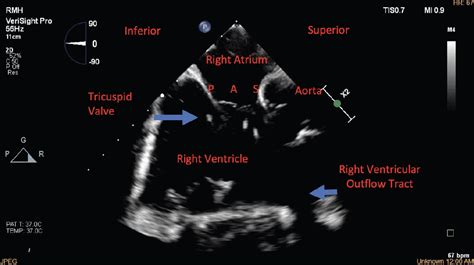 Three Dimensional Intracardiac Echocardiography Use In Tricuspid Valve