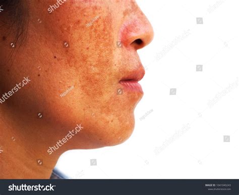 Close Melasma On Woman Face Skin Stock Photo Edit Now 1041040243