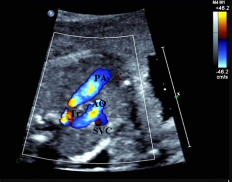 Fetus 1 25þ Weeks Of Gestation The Image Shows Three Vessel Trachea