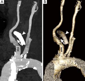 Computed Tomography Angiography Diagnosis Of Tracheo Innominate Fistula A Case Report And