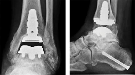 Current And Emerging Insights On Total Ankle Replacement