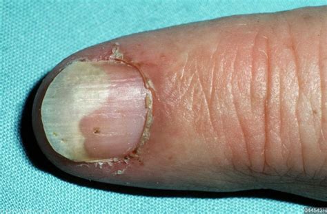 Nail Psoriasis Pictures Pictures Photos