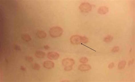 Fnf Doc — Tinea Versicolor Common Skin Disease
