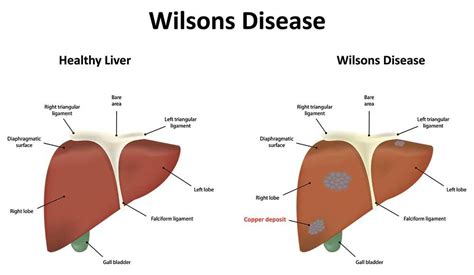 Wilsons Disease Prof Aftab Ala Gastroenterologist Surrey