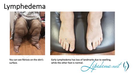 Differences Between Lymphedema And Lipedema