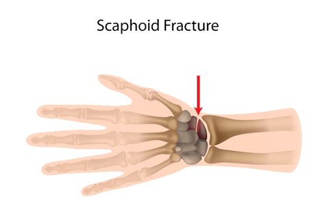 Hand & Wrist Injuries - Carpal Tunnel - Arthritis | Dr ...