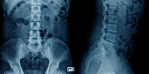 radiografía de columna lumbar 2 posiciones en hospital san josé tecsalud store