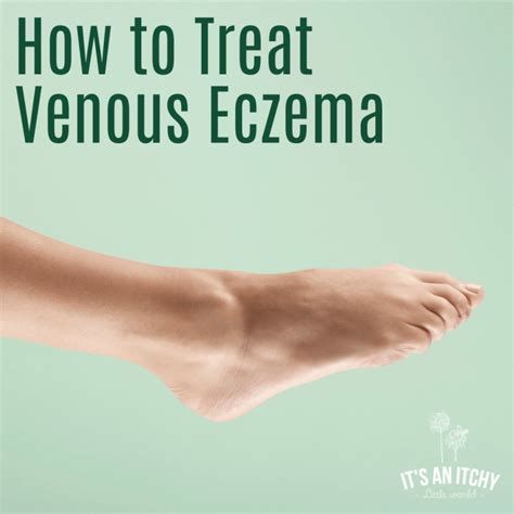 What Is Venous Eczema Its An Itchy Little World