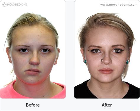 Asymmetrical Face Surgery Before And After