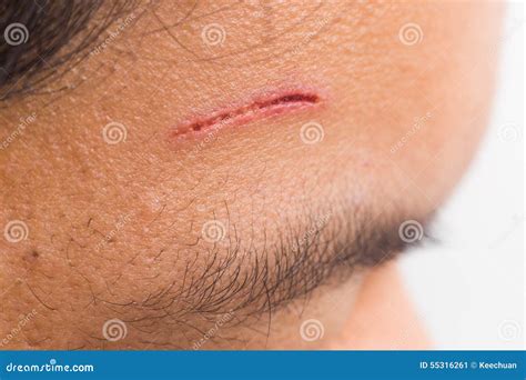 Close Up Of Painful Wound On Forehead From Deep Cut Stock Image Image
