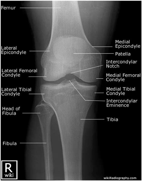 Adult Knee Radiographic Evaluation Recon Orthobullets