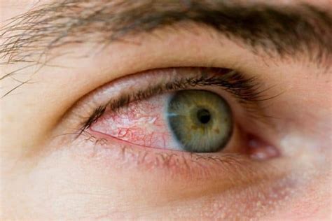 Derrame Ocular Causas Síntomas Y Tratamiento La Guía De Las Vitaminas