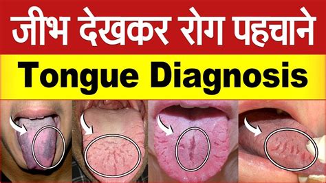 Tongue Diagnosis Cracked Tongue Causes And Acupressure Treatment Tcm Diagnosis Youtube