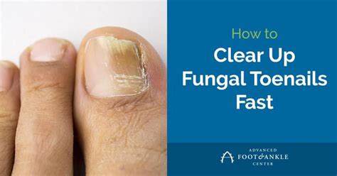 The 8 Minute Rule For How To Deal With Toenail Fungus The Natural Way