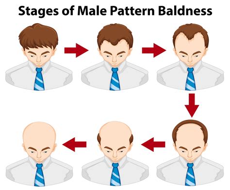 Diagram Showing Stages Of Male Pattern Baldness Illustration