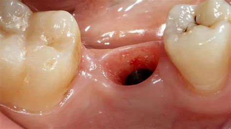 Alveolitis After Tooth Extraction Causes Symptoms And Treatments