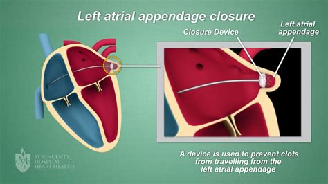 Anatomy Of Left Atrial Appendage