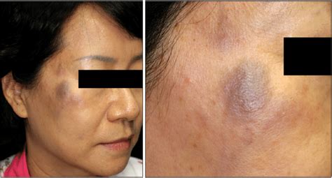 Several Brownish To Bluish Nodules And Plaque On The Right Cheek And
