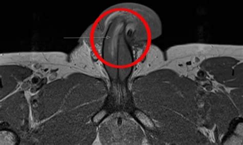 Médicos Estudian El Primer Caso Del Mundo De Una Fractura Vertical De