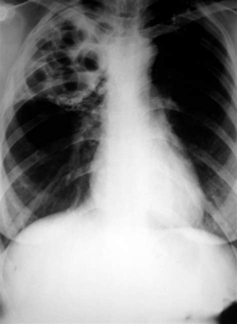Chest X Ray Miliary Tb