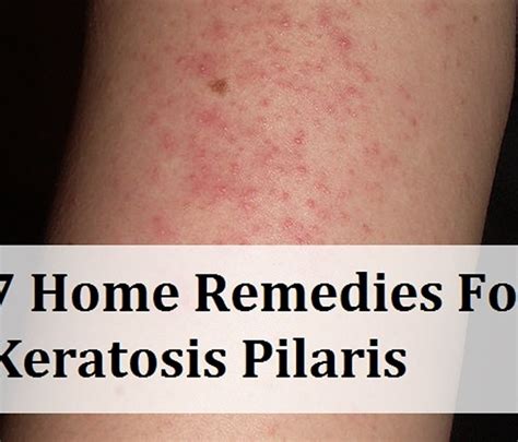 7 Home Remedies For Keratosis Pilaris