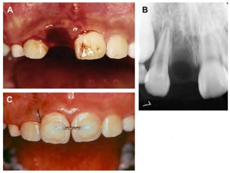 Tooth Avulsion Knocked Out Tooth Due To Trauma Attention Coaches