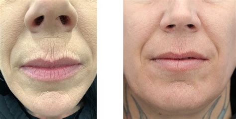 Profractional Perioral Bismarck Nd Pure Skin Aesthetic And Laser Center