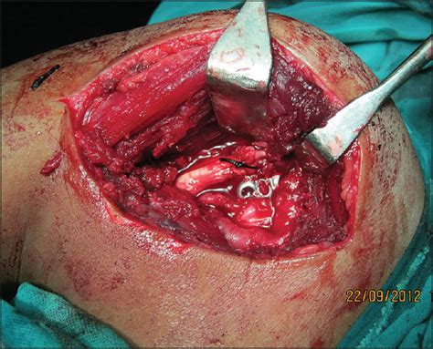Isolated Lesser Tuberosity Avulsion With Rupture Of Long Head Of Biceps