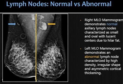 Pin On Breast Imaging