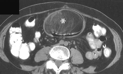 Imaging Characteristics Of Gastric Lipomas In 16 Adult And Pediatric