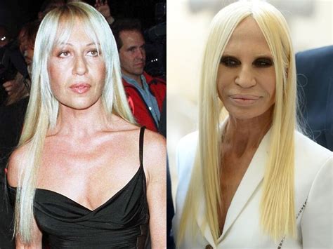 Donatella Versace Before And After Plastic Surgery Celebrity Plastic Surgery Online
