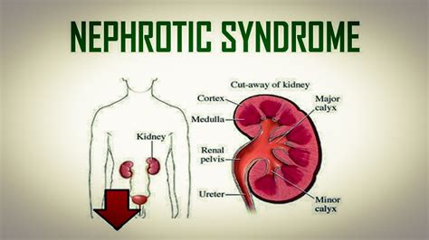 What Is Nephrotic Syndrome Signs Symptoms Causes Diagnosis And